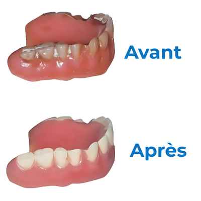 BioDent Pure™ – Nettoyage Clinique de Vos Prothèses et Appareils Dentaires à Domicile